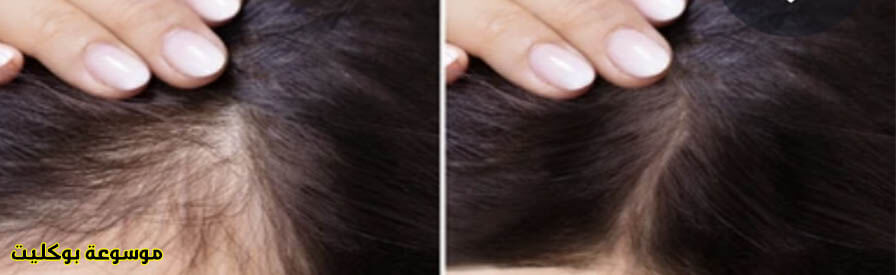 علاج تساقط الشعر للرجال والنساء