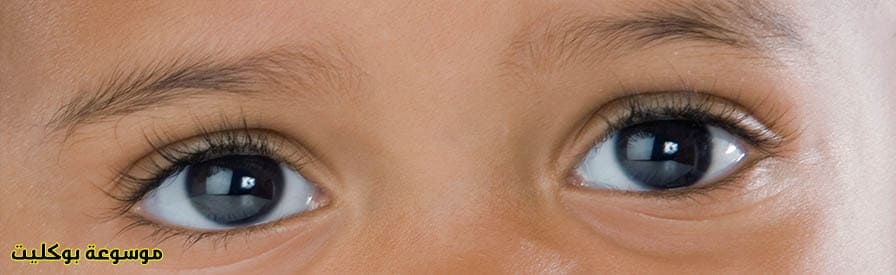 علاج حركة العين اللاإرادية عند الأطفال نهائيًا